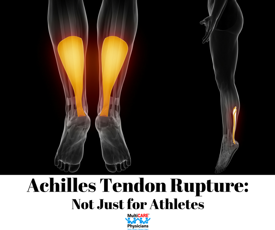 Achilles Tendon Rupture Not Just For Athletes Multicare Physicians